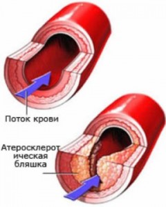 Увеличение частоты атеросклероза